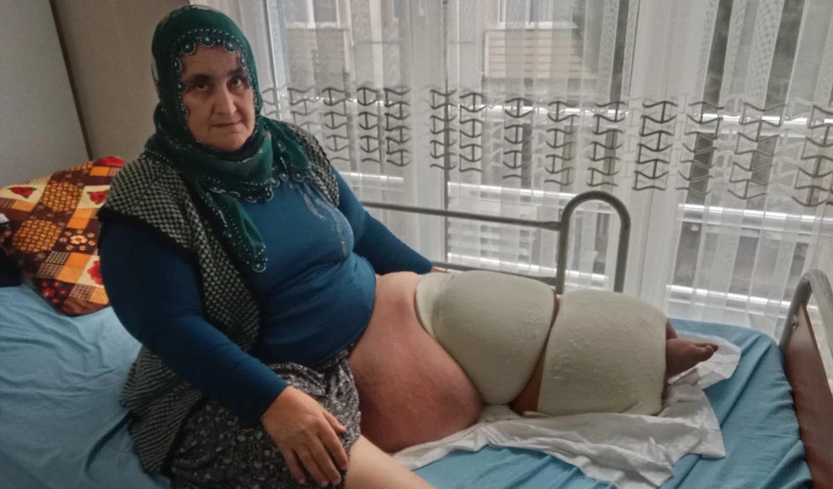 Fil hastalığı bacağını 100 kilo yaptı, tedavisinin devamı için destek bekliyor