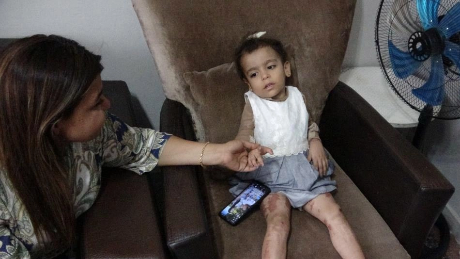 Küçük Ayşe yaşam savaşını kazandı, özel tedaviyle hayata tutundu